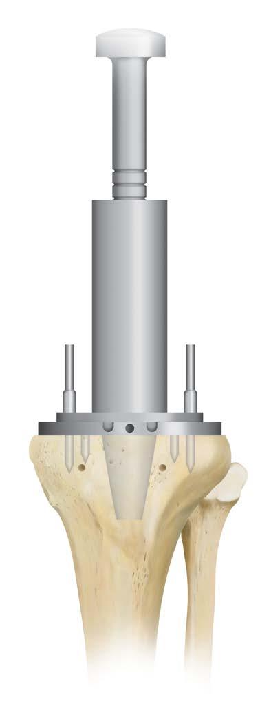 4-7 2-3 1-1.5 Selected Tray Size Selected Tray Size (figure 49) (figure 50) Note: The MBT drill creates a cavity that is line-to-line with the punch bushing and final implant.