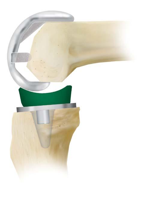 (figure 57) (figure 58) Flex the knee 100 to 120 degrees and slide the femoral trial into position using the two peg holes and anterior surface for guidance (Figure 57).