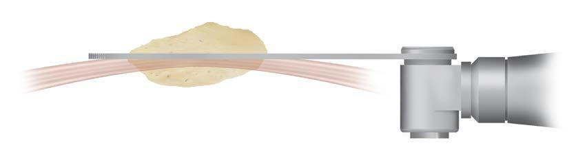 Resect articular bone thickness approximately equal to the implant s overall thickness.