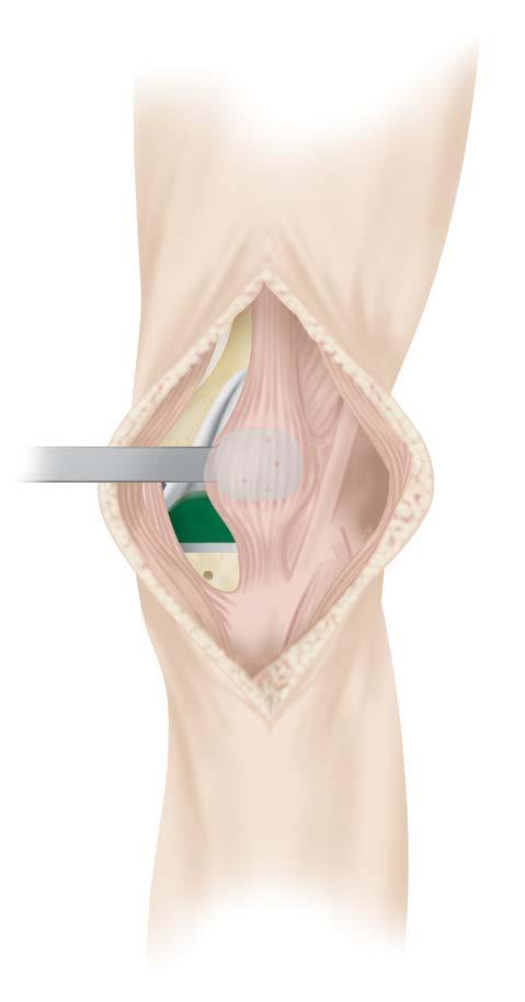 PATELLAR TRIAL (figure 61) (figure 62) Place the thin patellar template that matches the femoral component s size over the trial femoral component and perpendicular to the long axis of the extremity
