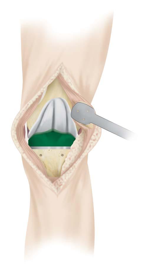 Flex the knee and assure that the patellar template remains perpendicular to the long axis of the extremity and parallel to the prosthetic joint line.