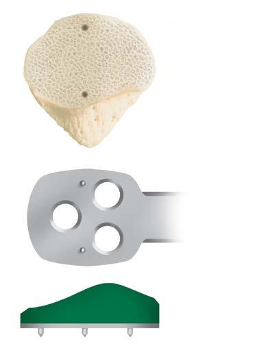 (figure 63) (figure 64) Remove the template and press the trial patellar component onto the resected patellar surface in the same location as the patellar template (Figure 63). Reduce the patella.
