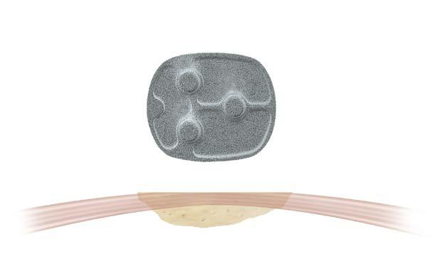 (figure 80) (figure 79) (figure 81) Patellar Implantation Apply methyl methacrylate cement to the prepared patellar surface.