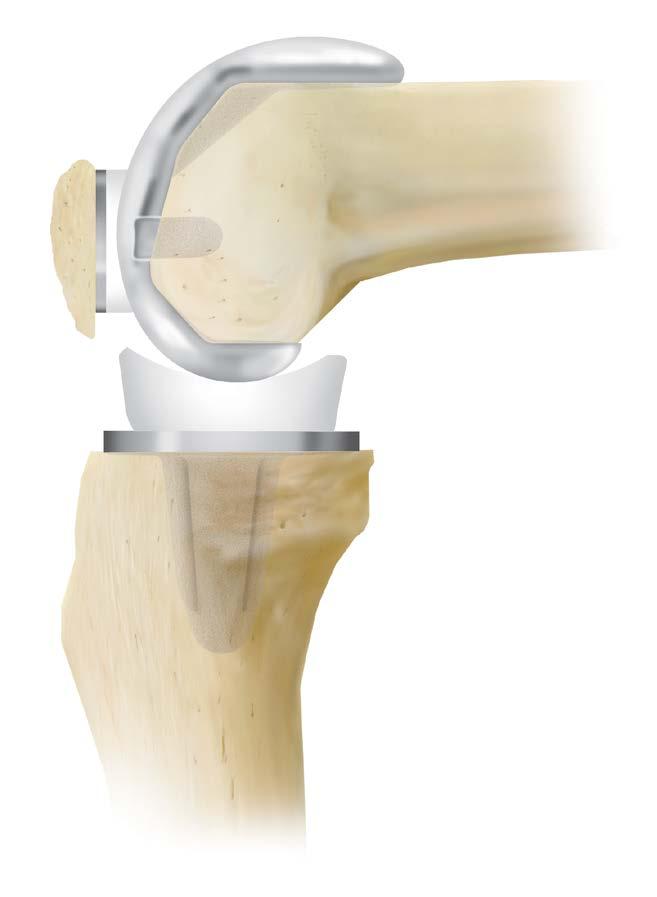 Final Implant Evaluation Reduce the patella and evaluate the implants. Ensure that unrestricted range of motion, free bearing movement and proper patellar tracking are occurring (Figure 82).