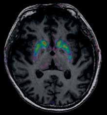In our facility, our research has found that PET imaging provides early biomarkers of many neurodegenerative disorders, but MR provides unique imaging information on age-related or pathological