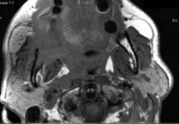 A B C D E F Figure 4. PET/MR exam of a squamous cell carcinoma of the right intermaxillary commissure. PET/MR enables precise tumor delineation for pre-surgical planning.