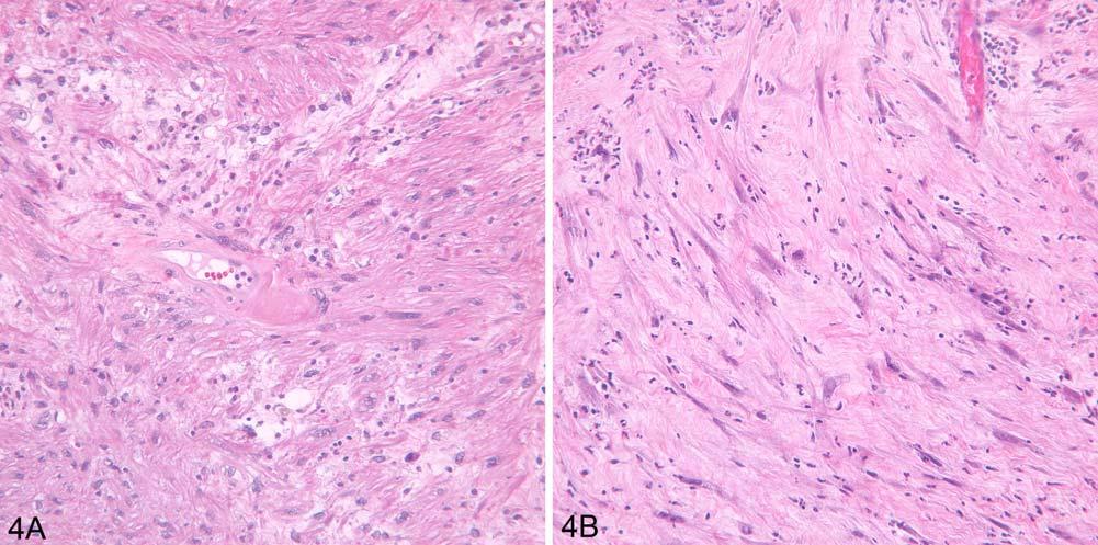 H&E, x100. Fig. (4). Complete response to chemotherapy showing fibrosis. (A) Spindle cells appear focally enlarged and show pleomorphism. H&E, x100.