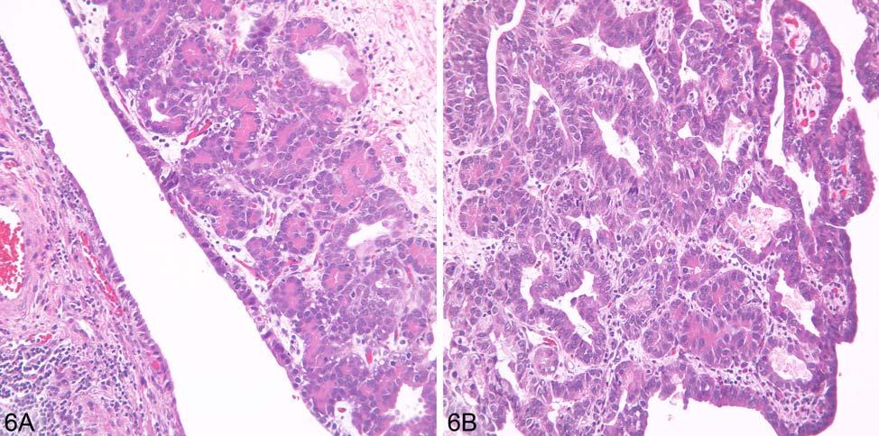 (B) Cystic structure mostly denuded of the epithelium is surrounded by stroma containing inflammatory cells. Smaller glands are seen in the adjacent stroma. H&E, x100. adenocarcinoma in situ.