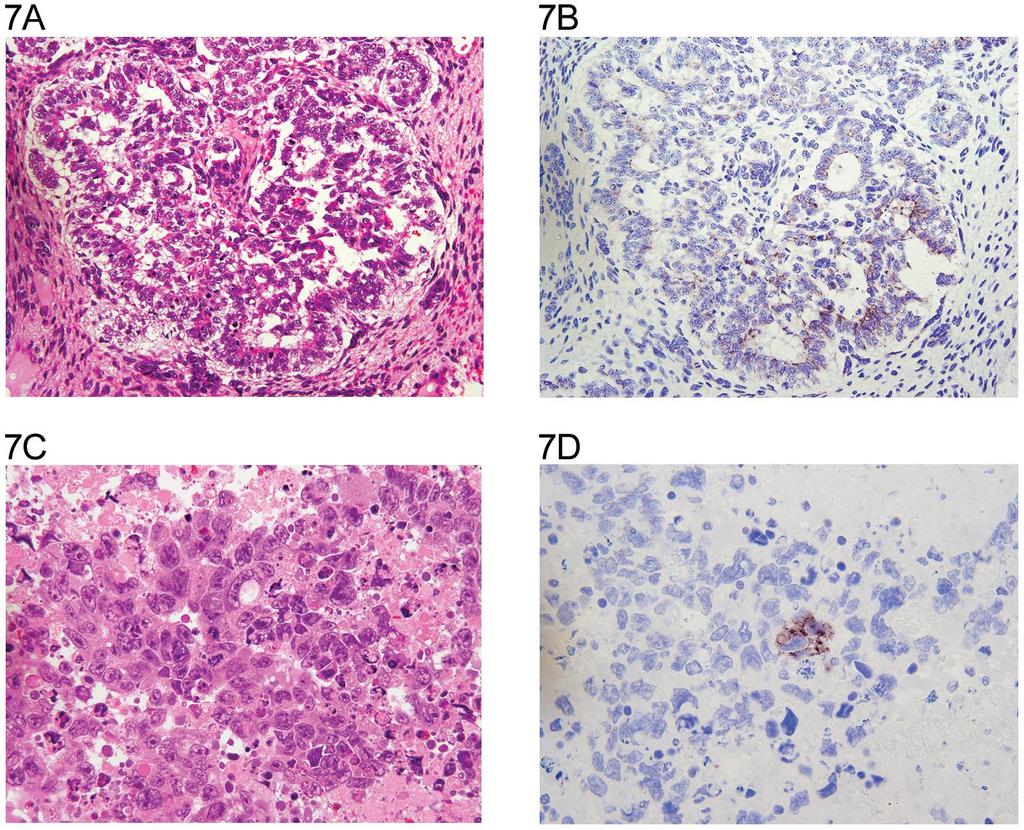 A: Embryonal carcinoma (H&E x 20). B: same field (anti N-cadherin x 20).