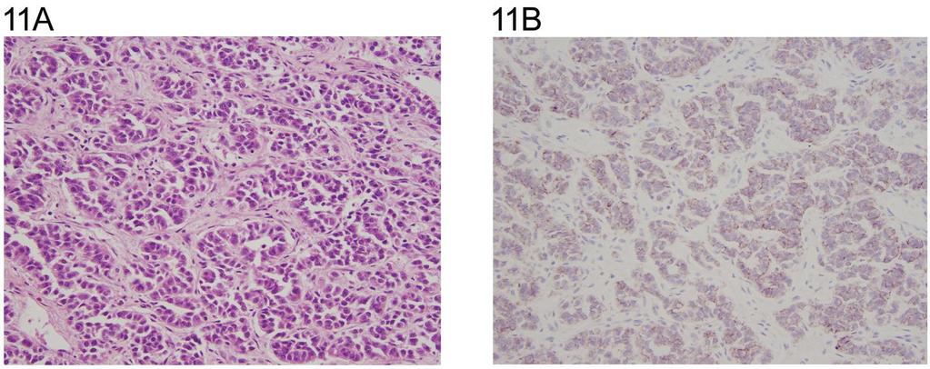 389 Fig. 11. A: Sertoli cell tumor (H&E x 20).
