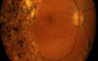 Falling incidence of proliferative retinopathy in type 1 DM DM onset 1965-69 1970-74 1975-79 1979-84