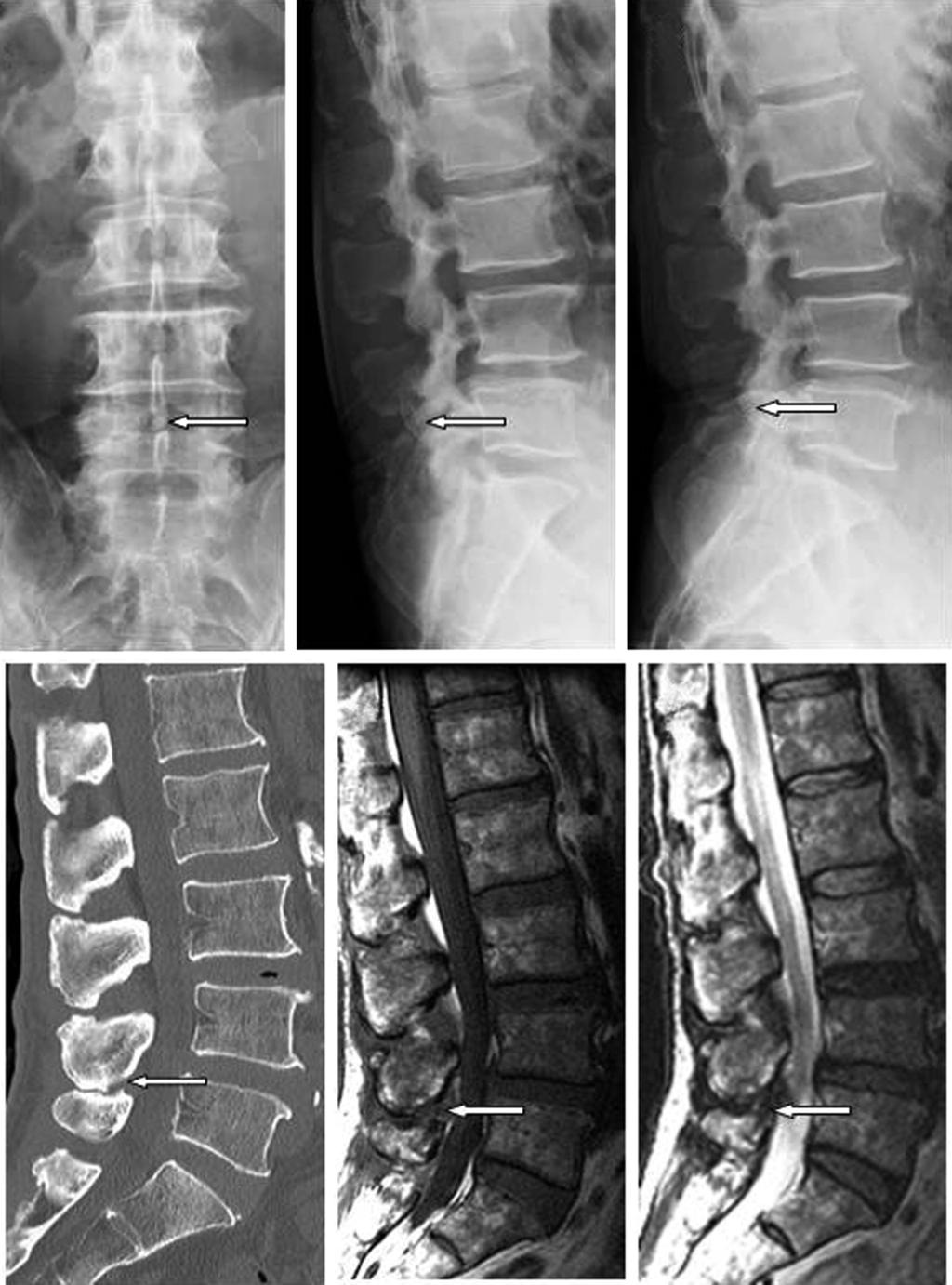 264 Kentaro Okada et al. A B C D E F Fig. 1. A 65-year-old man with severe low back pains between spinous processes. (A) X-ray films show kissing spine on Anterior-Posterior-views (arrow).