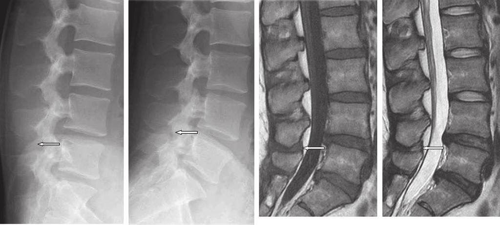 Asian Spine Journal Lidocaine and steroid injections for Baastrup s disease 265 A B C D Fig. 2. A 24-year-old man with severe low back pains between spinous processes.