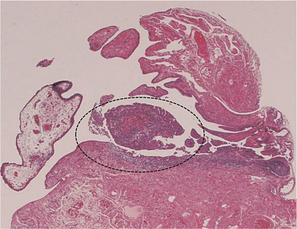 Jpn J Clin Oncol 2014 Page 3 of 5 Figure 2. View of the fimbriated end of the right fallopian tube under low power. Serous tubal intraepithelial carcinoma (STIC) is localized in the encircled area.