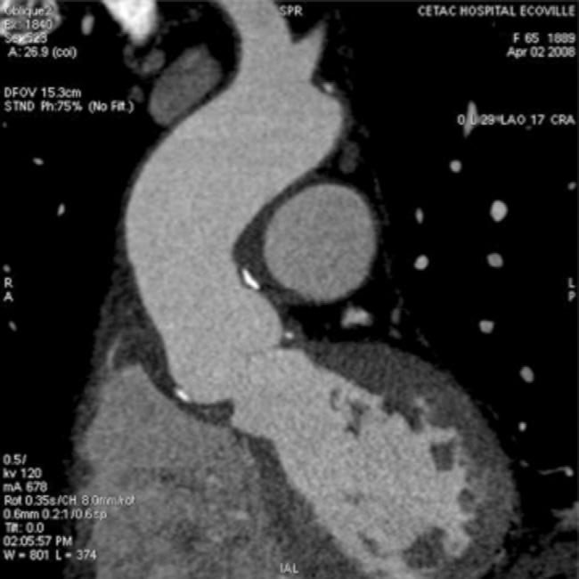 Ann Thorac Surg DA COSTA ET AL 2010;90:1854 61 DECELLULARIZED AORTIC VALVE ALLOGRAFTS 1857 Fig 2. Maximum instantaneous gradients after decellularized aortic valve allograft (DAVA) implantation.