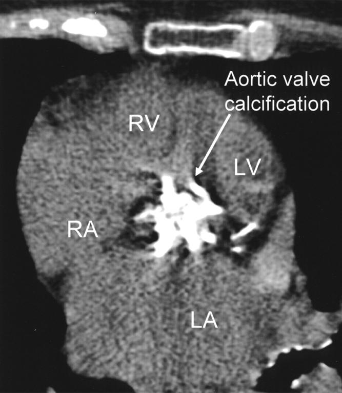 Fig. 4. 72-year-old man with mild aortic stenosis assessed at cardiac catheterization.