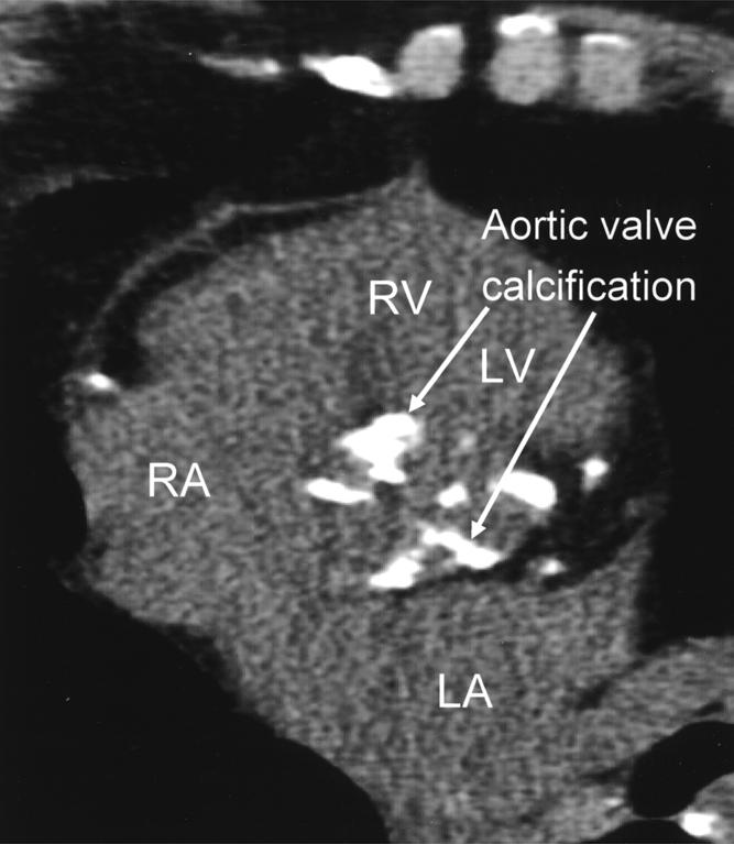 Locations of right ventricle (RV), left ventricle (LV), right atrium (RA), and left atrium (LA) are indicated. Fig. 5.