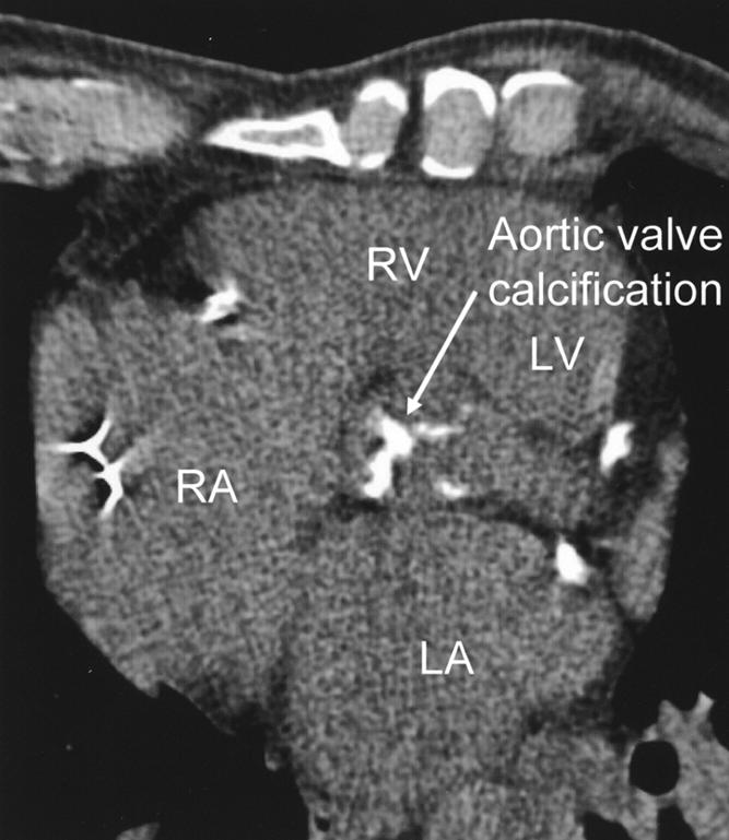 Multiplanar reformation of axial MDCT scans shows moderate calcification of aortic valve leaflets (aortic Agatston score 1,949; aortic volume score 1,597; aortic mass score 467).