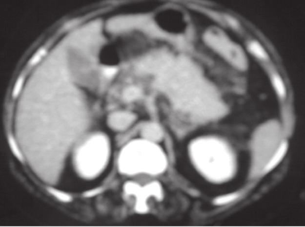 Grade C pancreatitis: CT abdomen showing diffuse swelling of pancreas with irregular outlines and inflammation of the peripancreatic fats. Fig.. were observed for the confirmation of diagnosis.