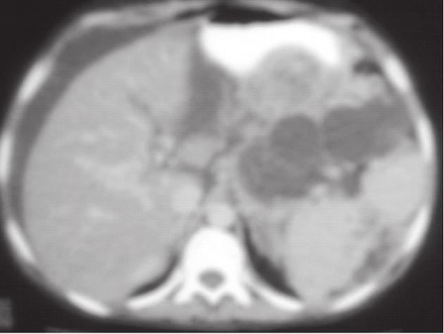 Grade E pancreatitis: CT is showing diffuse involvement of the pancreas, multiple fluid collections, pseudocyst formation and ascites. Fig.4.