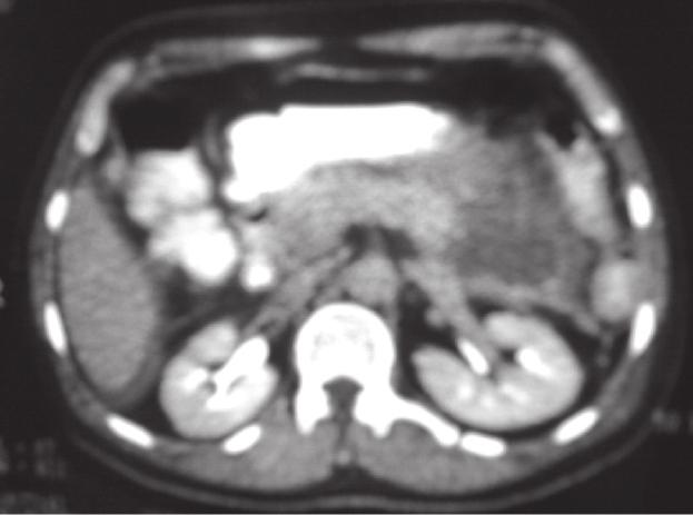 Pancreatic abscess: CT shows Grade D pancreatitis with abscess formation in the pancreatic tail region Fig.6.