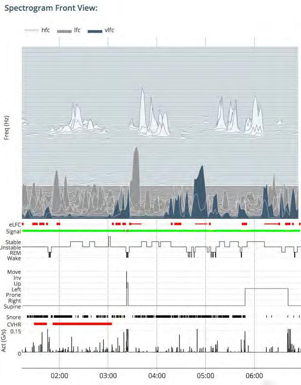 Patterns After an analysis for Associations, an overview of Patterns within the Traces below the Spectrogram in your SleepImage