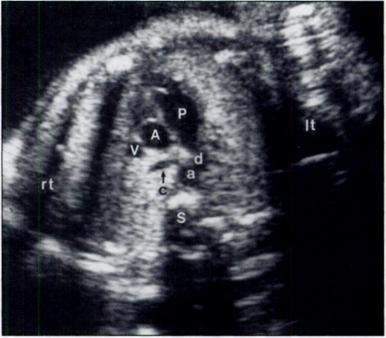 rt Pictorial Essay bnormalthree-vesselview on Sonography: Clue to the Diagnosis of Congenital Heart Disease in the Fetus screening tool for major congenital heart diseases [I. 2J.