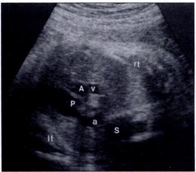 Yoo et al. :; -- - -$ :.*,.,.... -.: a.; : r+ Fig. 1.-Fetus of 31 weeks gestation with aortic valve stenosis and bilateral supenor venae cavae.
