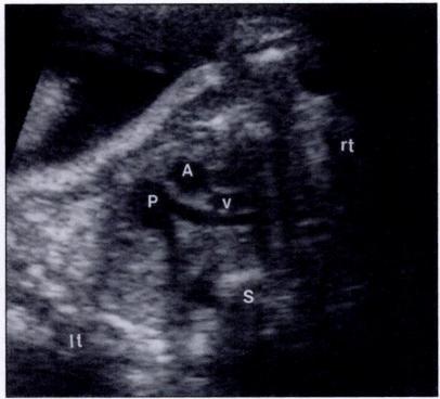 This form of abnormal alignment is seen in most cases of tetralogy of Fallot in which the dilated ascending aorta is displaced anteriorly and the small main pulmonary artery is displaced posteriorly
