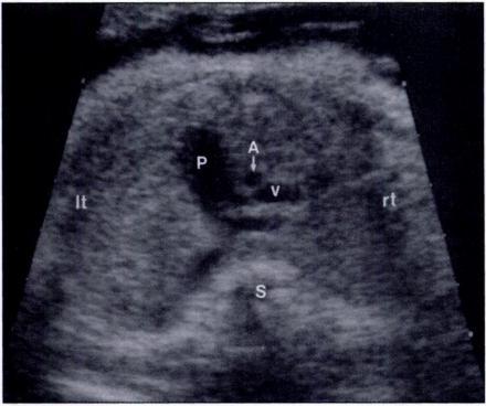 Occasional cases of complete transposition of the great arteries may show a similar arterial relationship. Fig. 8.-Fetus of 27 weeks gestation with pulmonary valve stenosis.