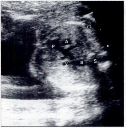 Sonography of Fetal Congenital Heart Disease Ii_._---_ -:- c.._ - -, T7:T,.., Fig. 11.-Fetus of 20 weeks gestation with persistence of left superior vena cava and absence of right superior vena cava.