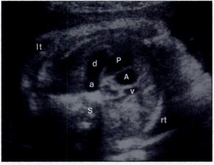 Only two vessels can be seen also in pulmonary atresia with a ventricular septal defect when the main pulmonary artery is atretic or absent.