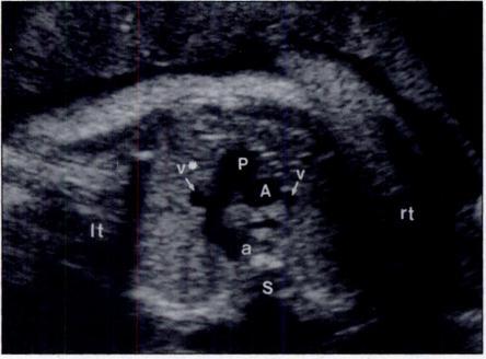 In late gestation, the ductus may become tortuous and its cross section may be seen as an additional vessel at the left posterior aspect of the main pulmonary artery (Fig. 14).