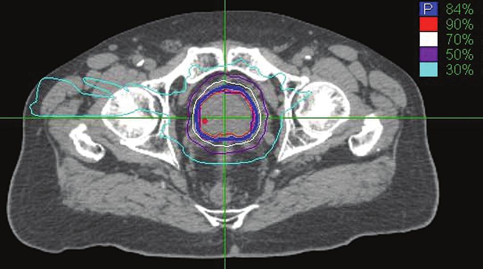468 Katz Dosimetry The majority of published CyberKnife prostate results to date perform what is known as homogeneous planning (Figure 1).