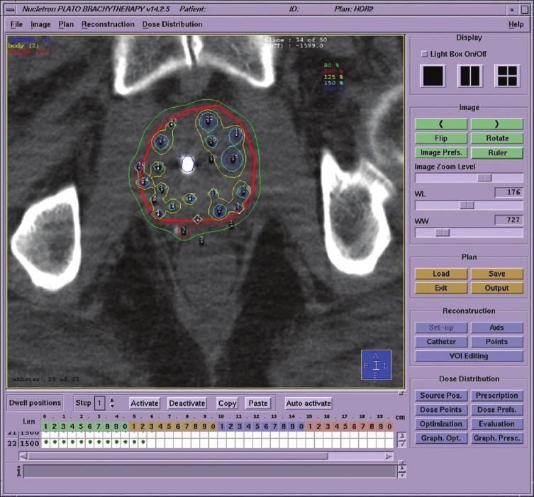 C H A PTER 29: CyberKnife Monotherapy for Prostate Cancer 329 Figure 3. Isodose distribution for a high dose rate (HDR) brachytherapy treatment. bladder are entered.