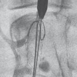 Early and late clinical outcomes of endovascular aneurysm repair in patients with an