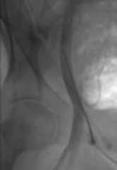 Clinical Considerations for Puncture Closing Using Vascular Closure Devices 1,4 High Stick (Access at or above the inguinal ligament) Right femoral angiogram shows high puncture into the external