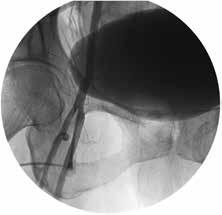 Clinical Considerations for Puncture Closing Using Vascular Closure Devices 4 (cont d) Low Stick (Access at or below distal femoral artery bifurcation) 9 Bifurcation