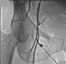 artery, the risk for complications is increased. Image courtesy of Asoka Balaratna, MD Right femoral angiogram shows low access via the profunda femoris artery.