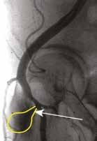 Low Stick Associated Complications Angiogram Showing Pseudoaneurysm 10 From this anteroposterior angiogram a pseudoaneurysm (outlined in yellow with