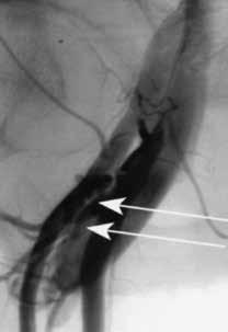 Narrowing of the distal common femoral artery is also observed.