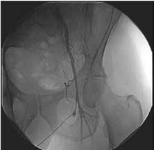 Clinical Considerations for Puncture Closing Using Vascular Closure Devices (cont d) Lower Limb Ischemia Image courtesy of Zoltan Turi, MD This left transfemoral access image shows the sheath at the