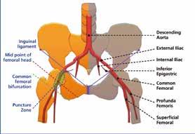 Femoral Arterial Anatomy Anatomy of the Femoral Access Site