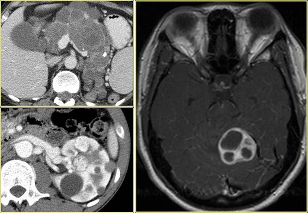 Fig. 28: Hemangioblastoma in a patient with Von Hippel-Lindau.