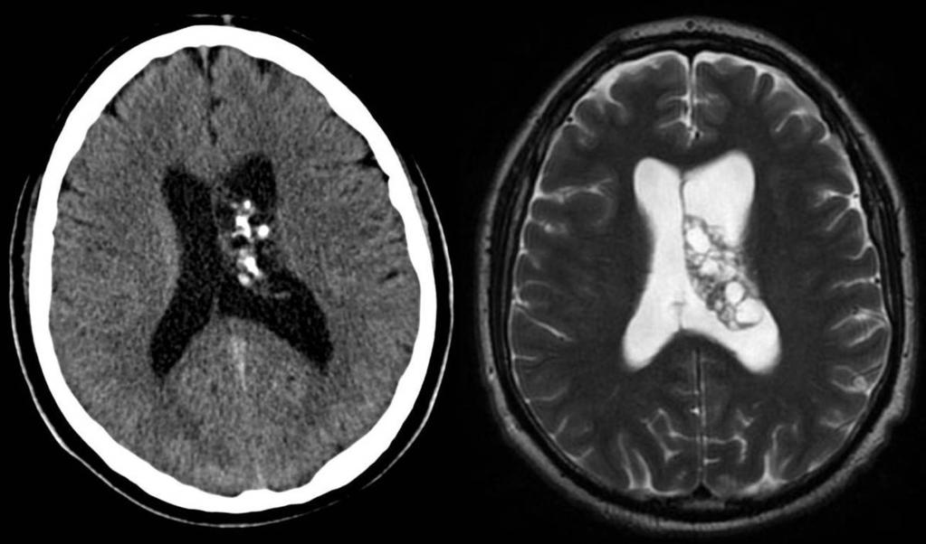 Fig. 31: Neurocitoma central. Imagenes de TC sin contraste y RM T2.