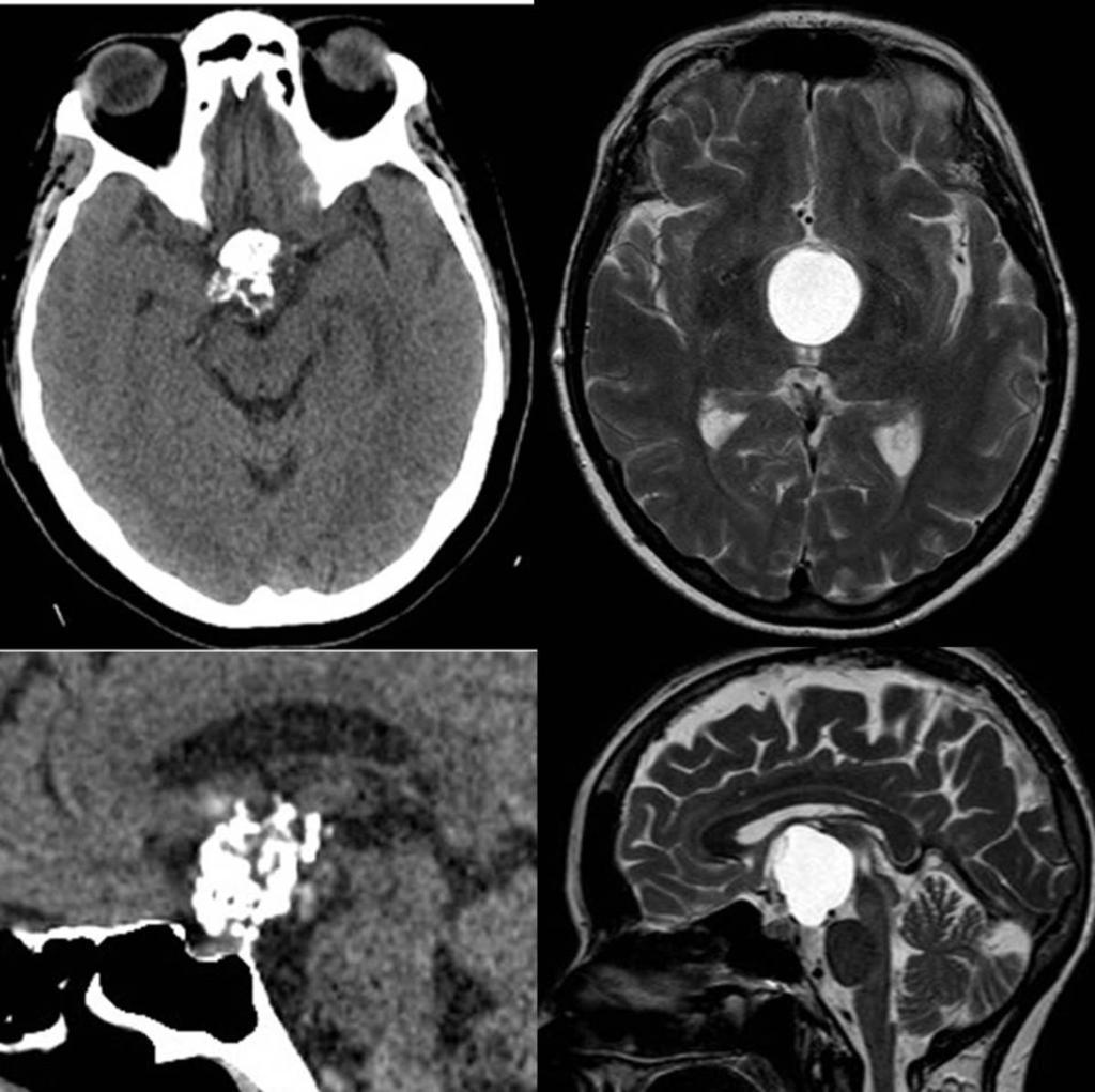 Fig. 32: Craniopharyngioma. Images on unenhanced CT and MRI (T2 sequence).