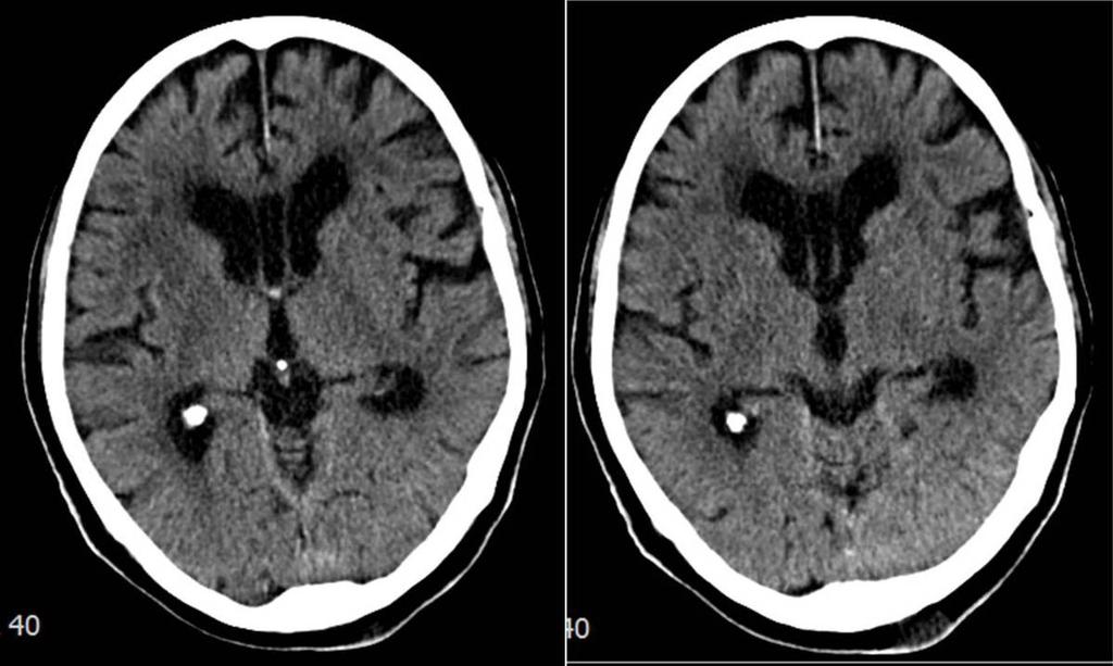 Craniopharyngioma: It has a bimodal incidence peaks at age 12 and another in middleaged adults. Its typical location suprasellar cystic component and calcification help us with the diagnosis. (Fig.