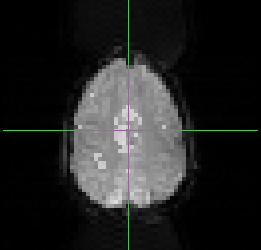 BOLD FMRI Activated state MRI signal arterioles CBV capillary bed venules increased flow decreased [Hbr] increased CBV increased MRI signal
