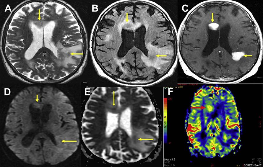 Author's personal copy Neuroimaging in Neuro-Oncology 181 Fig. 4. The patient is a 75-year-old man with a 1-month history of rapidly progressive cognitive decline.