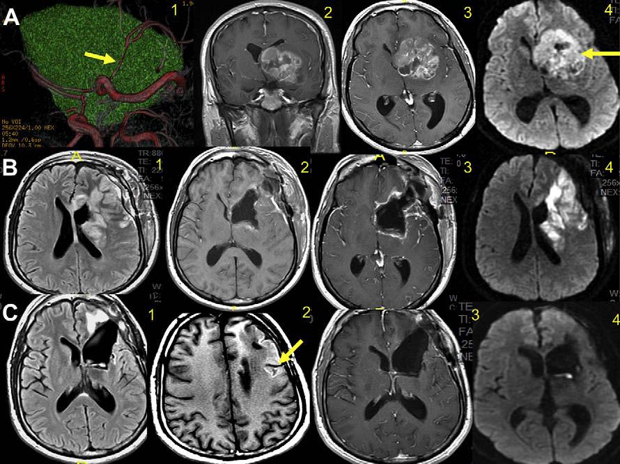 Author's personal copy Neuroimaging in Neuro-Oncology 187 Fig. 6.
